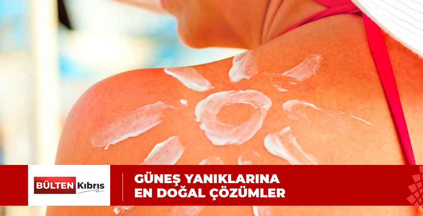 GÜNEŞ YANIĞINA DOĞAL ÇÖZÜMLER