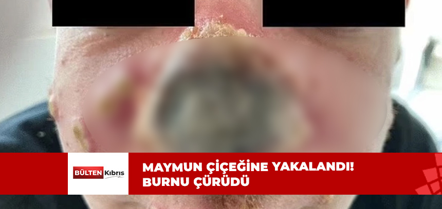 ADAMIN BURNU ÇÜRÜMEYE BAŞLADI!