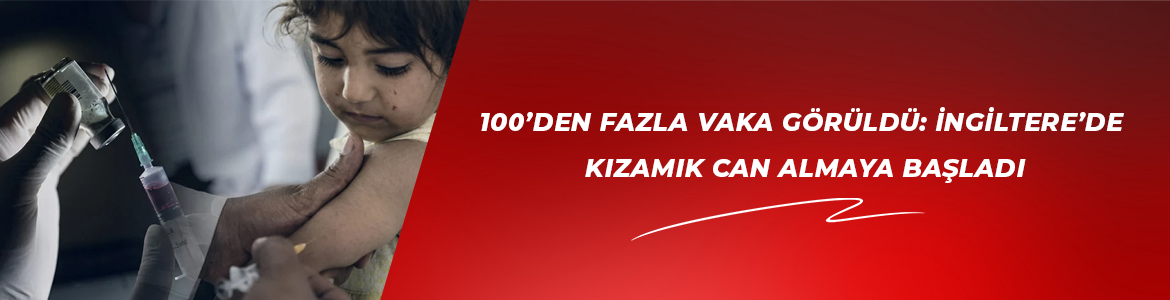 100’den fazla vaka görüldü: İngiltere’de kızamık can almaya başladı